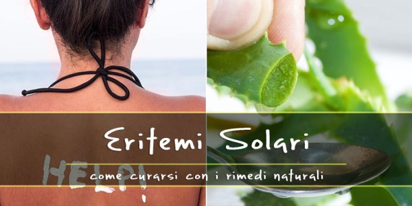 Eritemi solari? Questo rimedio in casa non può mai mancare….